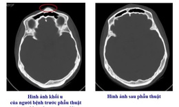 Bệnh viện Việt Nam - Thụy Điển Uông Bí phẫu thuật thành công ca u xương sọ hiếm gặp