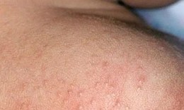 Mùa hè nhiều rôm sảy cần xử trí ra sao?