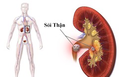 Nhập viện vì sỏi thận, chuyên gia khuyến cáo cần phát hiện sớm khi có biểu hiện này