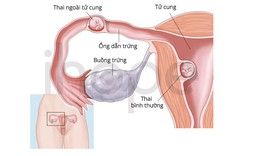 Hiếm gặp: Vừa có thai trong tử cung vừa có thai ngoài tử cung