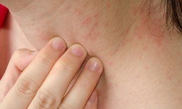 Mẩn ngứa ở trẻ cần xử trí như thế nào?