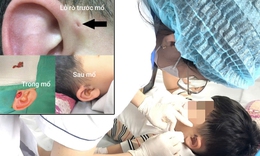 Hi hữu ca rò luân nhĩ di truyền qua 3 thế hệ