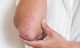 Người mắc bệnh vảy nến đối mặt áp lực tâm lý kéo dài nhiều năm