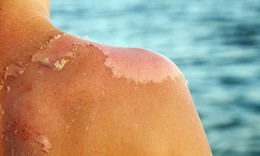 Bỏng nắng phải làm gì để tránh tổn thương da nghiêm trọng?