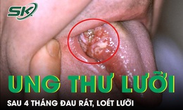 Loét lưỡi suốt 4 tháng, người đàn ông phát hiện ung thư ở tuổi 33 
