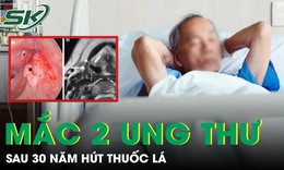 Người đàn ông 56 tuổi mắc cùng lúc hai ung thư sau 30 năm hút thuốc lá