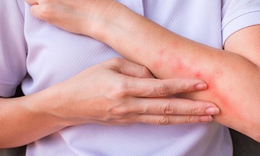 Nắng nóng khiến nguy cơ viêm da gia tăng, phòng ngừa thế nào?