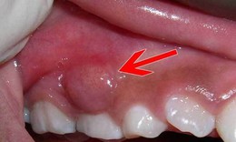 Cảnh báo biến chứng nguy hiểm của áp xe răng