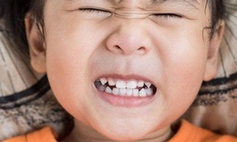 Răng cửa ngả vàng ở trẻ có ảnh hưởng gì đến sức khỏe?