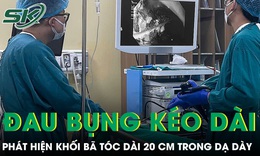 Bé gái 11 tuổi đau bụng kéo dài phát hiện khối bã tóc dài 20 cm trong dạ dày 