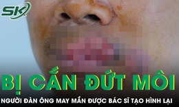 Người đàn ông bị cắn mất môi phải trải qua ca tạo hình phức tạp 