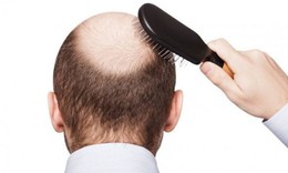 Rụng tóc ở nam giới là dấu hiệu bệnh gì?