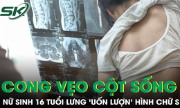 Tự ý ngừng đeo nẹp vì sợ bạn bè trêu chọc, nữ sinh 16 tuổi đối mặt nguy cơ mổ cột sống