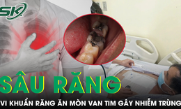Hơn 10 chiếc răng sâu khiến người đàn ông 57 tuổi bị vi khuẩn ăn mòn van tim