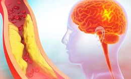 5 dấu hiệu cảnh báo thiếu máu não do hẹp động mạch cảnh