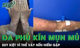 Da phủ kín mụn mủ, nữ bệnh nhân 28 tuổi suy kiệt vì thể vảy nến hiếm gặp