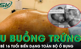 Bé gái 16 tuổi mang hai khối u buồng trứng khổng lồ gần 15kg, biến dạng toàn bộ ổ bụng