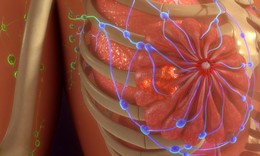 Công nghệ điều trị ung thư mới không cần dùng thuốc