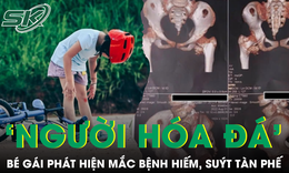 Bé gái cứng khớp suốt 2 năm sau cú ngã nhẹ, bác sĩ phát hiện mắc bệnh 'người hóa đá'