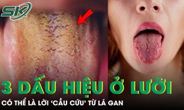 Đừng bỏ qua 3 dấu hiệu bất thường này trên lưỡi, có thể là lời 'cầu cứu' từ lá gan