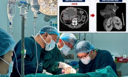 U gan 2 cm 'phình' lên 20 cm do tự điều trị bằng thuốc nam