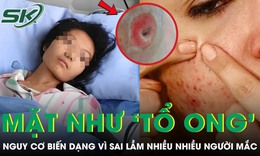 Người phụ nữ chết lặng khi thấy mặt như 'tổ ong', nguy cơ biến dạng vì sai lầm nhiều người mắc
