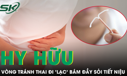 Ngỡ viêm đường tiết niệu, người phụ nữ bất ngờ phát hiện vòng tránh thai 'lạc' vào bàng quang
