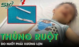 Hai trẻ bị thủng ruột, viêm phúc mạc do nuốt phải xương lợn