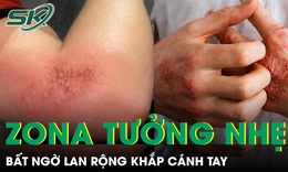 Zona tưởng nhẹ bất ngờ lan rộng khắp cánh tay khiến du khách trẻ nhập viện 