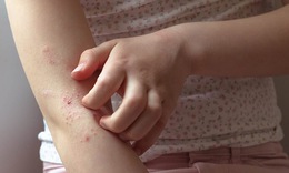 Dấu hiệu ngứa do ký sinh trùng