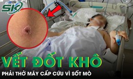 Người phụ nữ 49 tuổi lâm bạo bệnh, phải thở máy cấp cứu chỉ từ một vết đốt khô