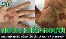 Ngứa khắp người nhiều tháng, bất ngờ phát hiện nhiễm cùng lúc sán lá gan và giun lươn 