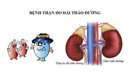 Thuốc SGLT2i - Bước tiến mới bảo vệ thận cho người bệnh đái tháo đường