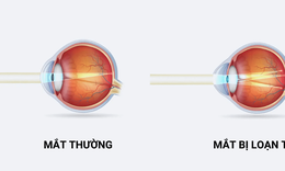 Trẻ bị loạn thị có cần đeo kính không?