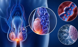 Tự kiểm tra giãn tĩnh mạch thừng tinh tại nhà bằng cách đơn giản