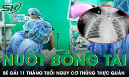 Nuốt phải bông tai kim loại, bé gái 11 tháng tuổi đối mặt nguy cơ thủng thực quản