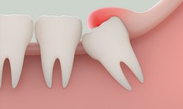 Nhổ răng khôn có nguy hiểm không, khi nào cần nhổ?