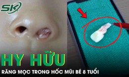 Răng mọc trong hốc mũi bé gái 8 tuổi