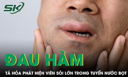 Đau hàm lâu ngày, người đàn ông tá hỏa phát hiện viên sỏi lớn trong tuyến nước bọt