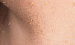 Vì sao mụn thịt thường mọc quanh mắt, xử trí thế nào?