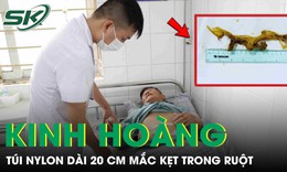 Kinh hoàng: Túi nilon dài 20 cm mắc kẹt trong ruột bệnh nhân