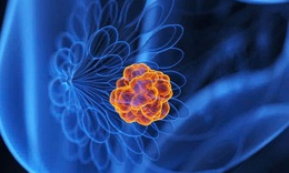 5 bí quyết giúp bạn chủ động phòng ngừa ung thư vú