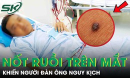 Người đàn ông nguy kịch từ nốt ruồi nhỏ, bác sĩ chỉ mặt dấu hiệu "chí mạng" nhiều người bỏ qua