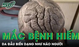 Da đầu biến dạng như não người, chàng trai 23 tuổi mắc bệnh hiếm