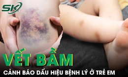 Trẻ bỗng xuất hiện nhiều vết bầm tím, bác sĩ cảnh báo dấu hiệu không nên bỏ qua 