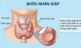 Bướu nhân tuyến giáp, nên mổ hay đốt sóng cao tần?