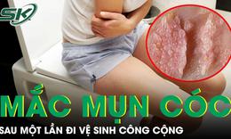 Kiêng quan hệ nhiều năm, cô gái vẫn mắc mụn cóc sinh dục sau một lần đi vệ sinh công cộng 