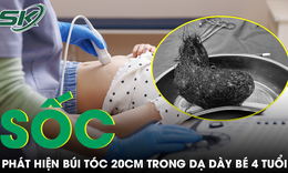 Bé gái 4 tuổi đau bụng triền miên, bác sĩ sốc khi lấy ra búi tóc dài gần 20cm trong dạ dày