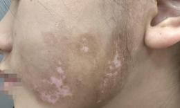 Bệnh bạch biến có thể phòng ngừa không?