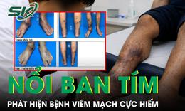 Nổi nốt đỏ tím khắp người, nam thanh niên phát hiện mắc bệnh viêm mạch cực hiếm 
